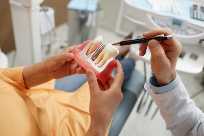 Zubné implantáty ako skvelé riešenie pre vás: Aké výhody prinášajú?